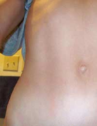 Belly Button Surgery Umbilicoplasty