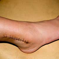 Scarring Surgery Procedure Treatments